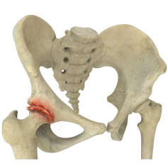 Hip Arthritis