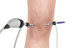 Outpatient Total Knee Replacement