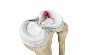 Meniscus Tears of the Knee