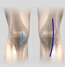 Minimally Invasive Knee Replacement