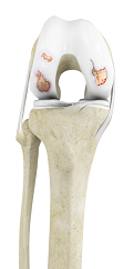 Osteoarthritis of the Knee