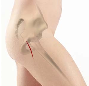 Posterior hip replacement