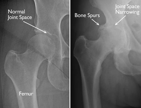 Hip Arthritis