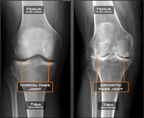 Knee Arthritis